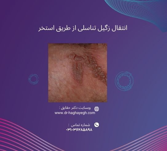 انتقال زگیل تناسلی از طریق استخر