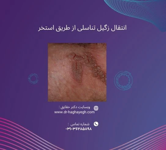 انتقال زگیل تناسلی از طریق استخر