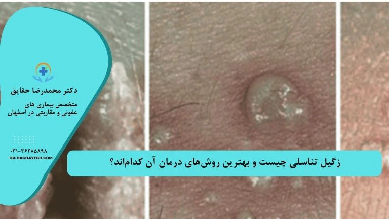 دکتر زگیل تناسلی در اصفهان | بهترین متخصص زگیل تصویر زگیل تناسلی اصفهان